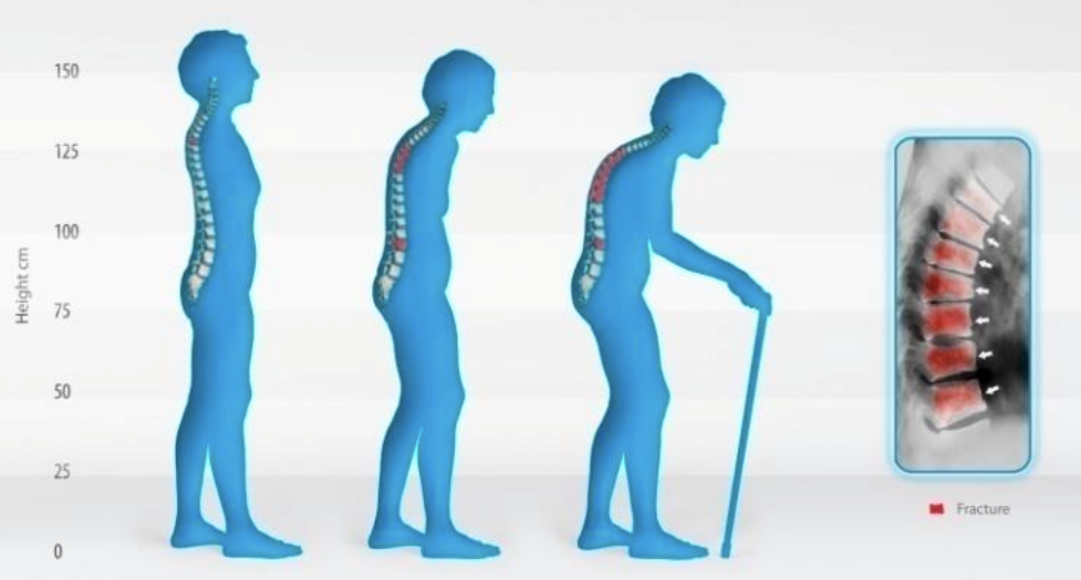 osteoporosis_3 image osteoporosis_3 Rumah Sakit Islam Jakarta Cempaka Putih - Bagaimanakah Gejala dan Tanda Tulang Keropos/Osteoporosis?